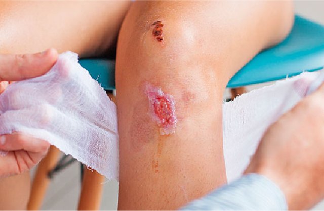 5 mitos y realidades en heridas