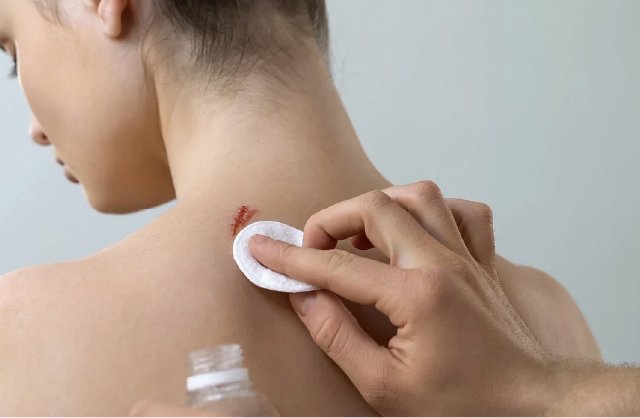 5 mitos y realidades en heridas